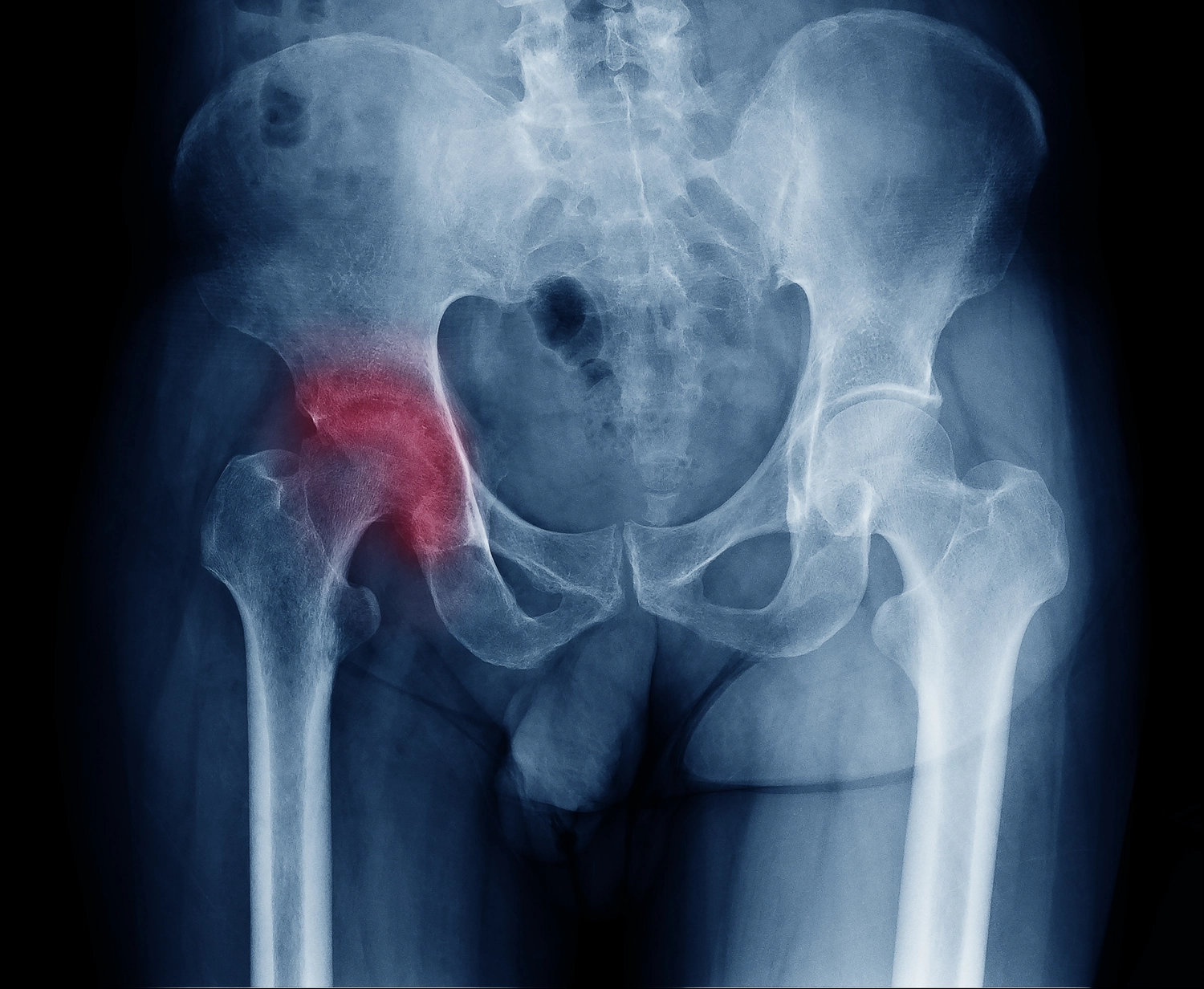 Dr. Tareq Soumma Cum Laude - Orthopäde für Hüfte - Röntgenbild einer schmerzenden Hüfte bei einem Mann mit Arthrose im rechten Hüftgelenk an der roten Bereichsmarkierung