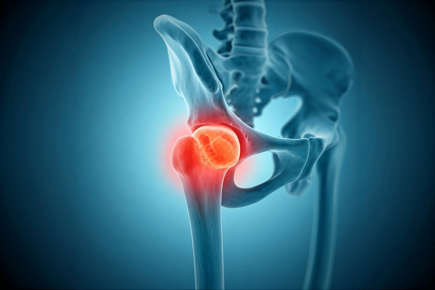 Dr. Tareq Soumma Cum Laude – Orthopäde für Hüfte – Röntgenaufnahme eines menschlichen Hüftgelenks mit rot hervorgehobenem Schmerzbereich.